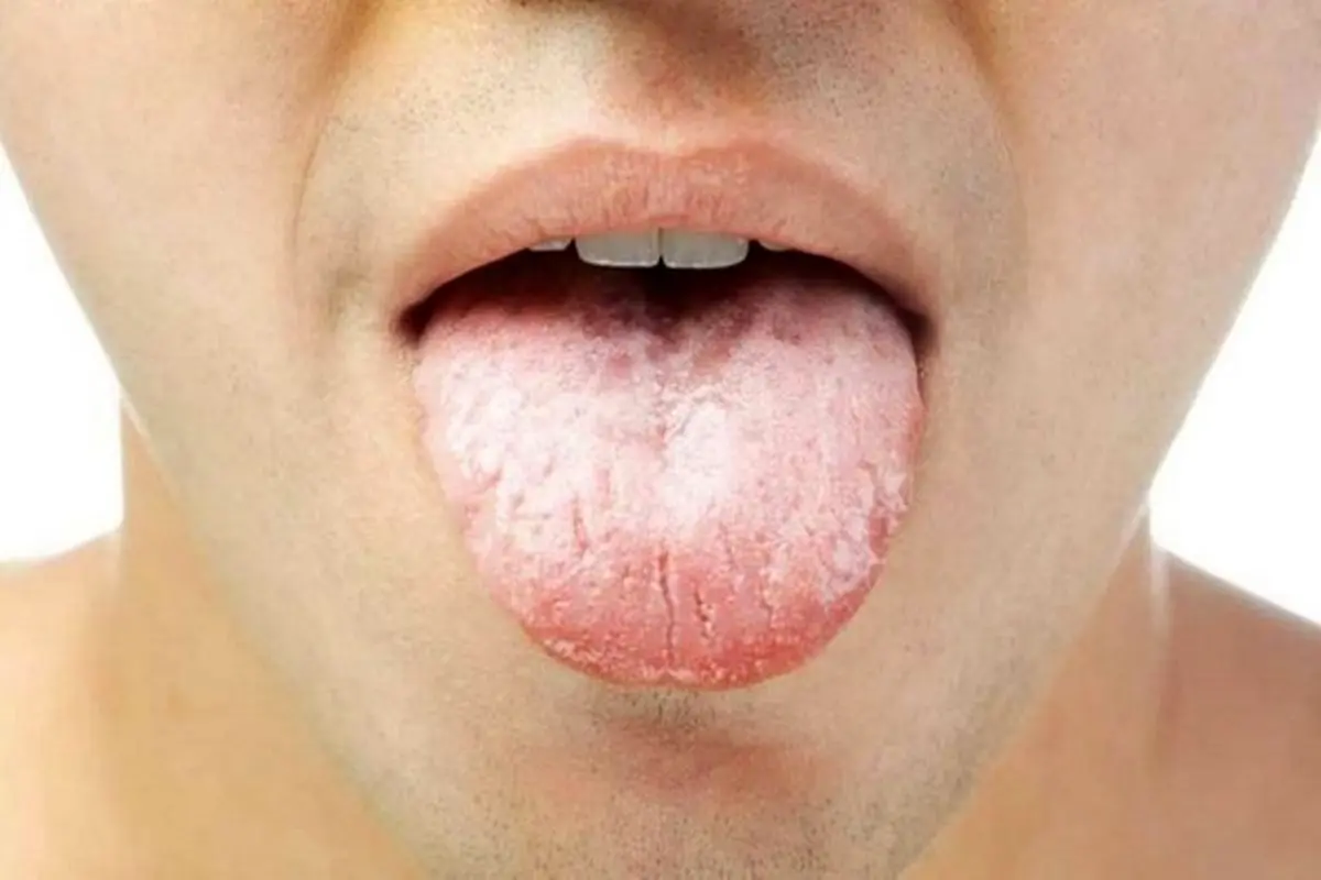 علل بوی بد دهان ناشی از چیست؟