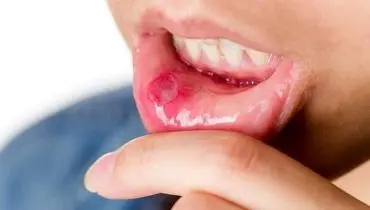 هشدار؛ این زخم‌ها در صورت و دهان سرطانی هستند