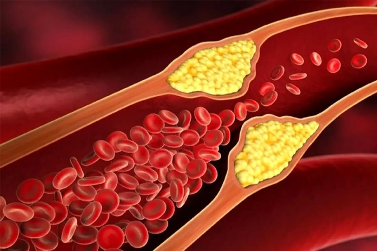 بهترین راهکار‌ها برای کاهش سطح کلسترول خون