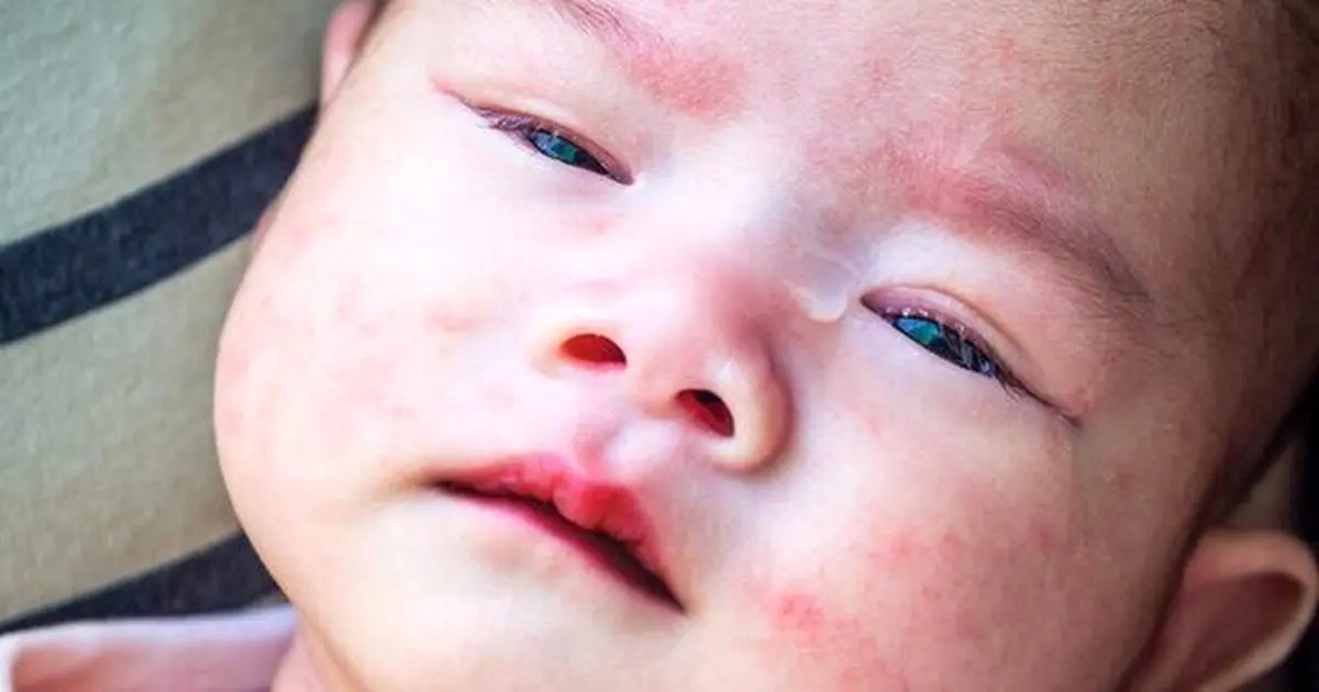 آیا بیماری کاوازاکی مسری است؟