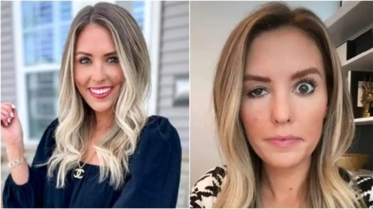 بلایی که بوتاکس بر سر یک اینفلوئنسر اینستاگرام آورد +عکس