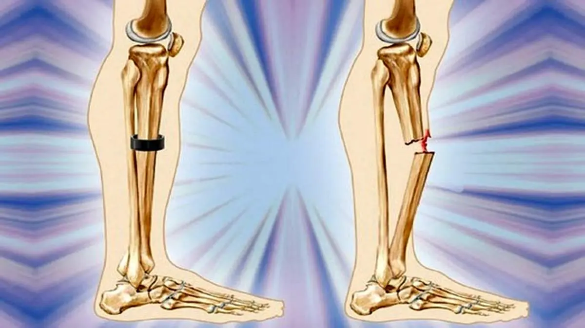 پلاتین بکار رفته برای درمان شکستگی باید خارج شود؟