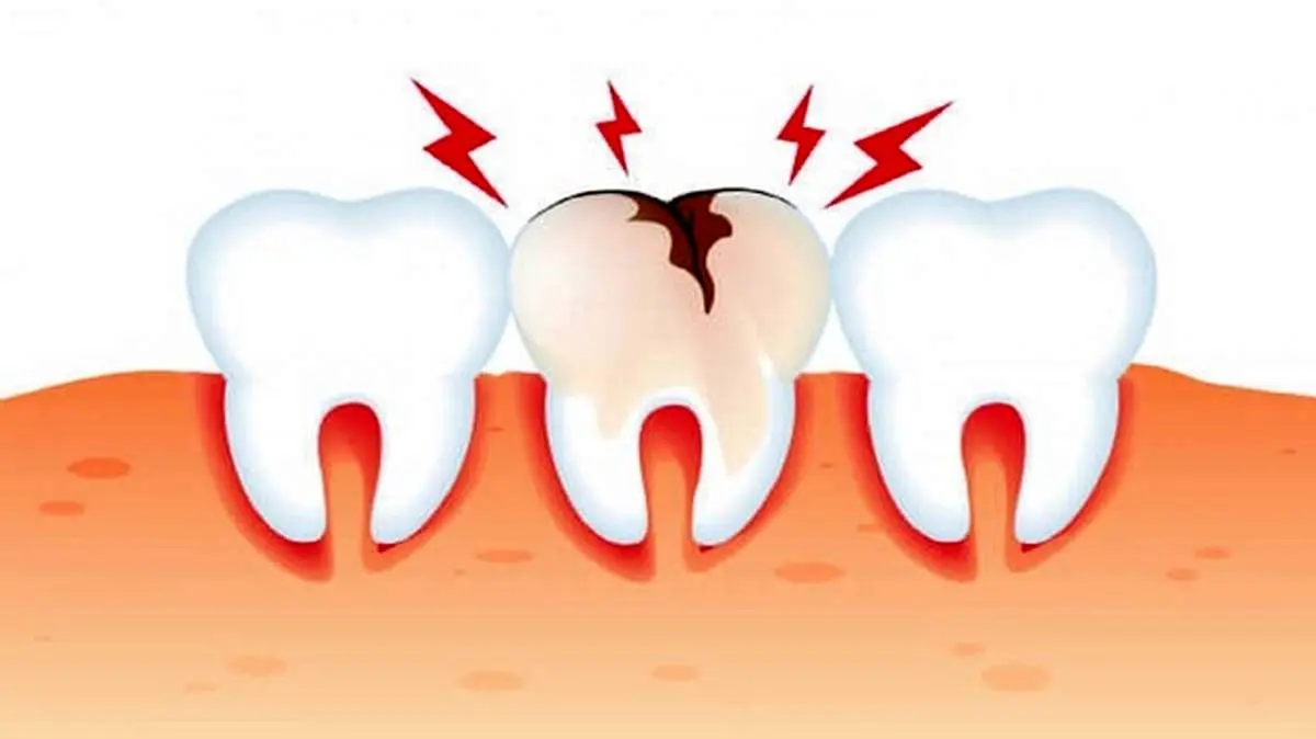 علت اصلی پوسیدگی دندان چیست؟