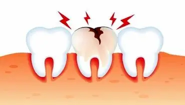 علت اصلی پوسیدگی دندان چیست؟