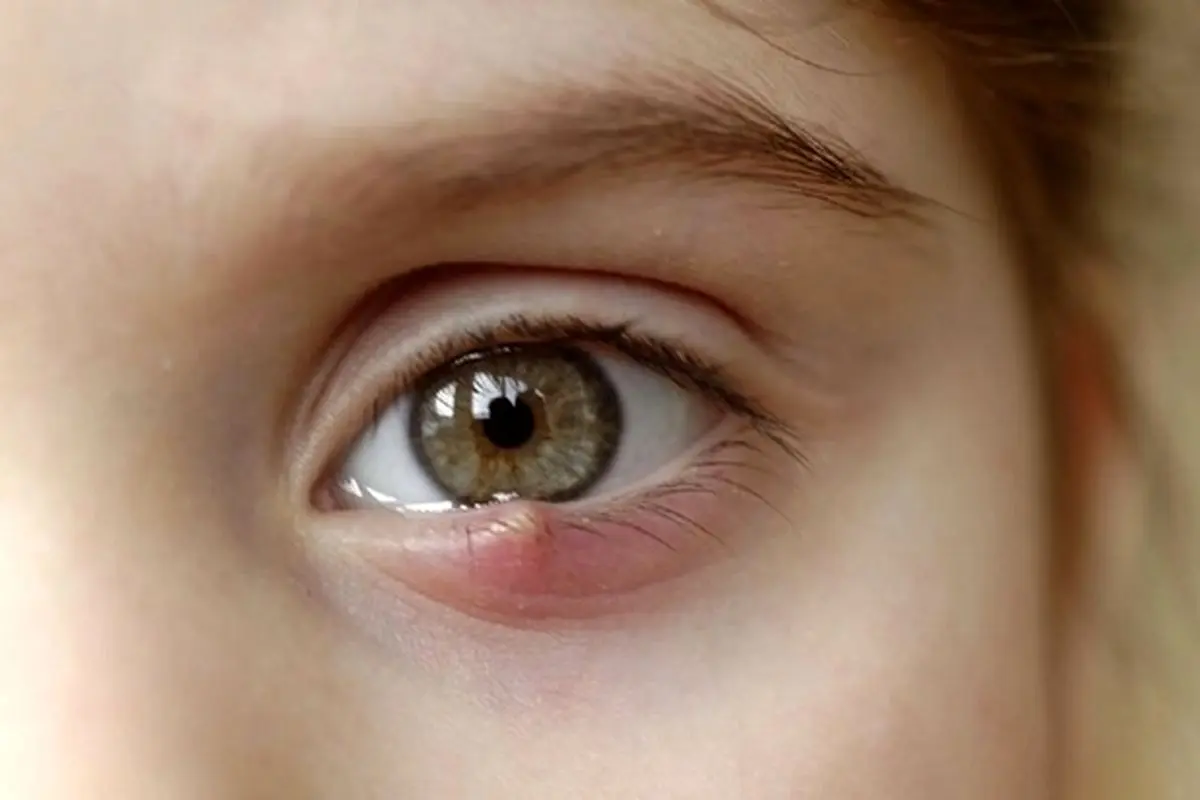 بیماری عفونی چشمی که باعث کوری خواهد شد