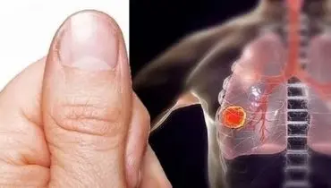 تغییر شکل انگشتان نشانه کدام بیماری است؟