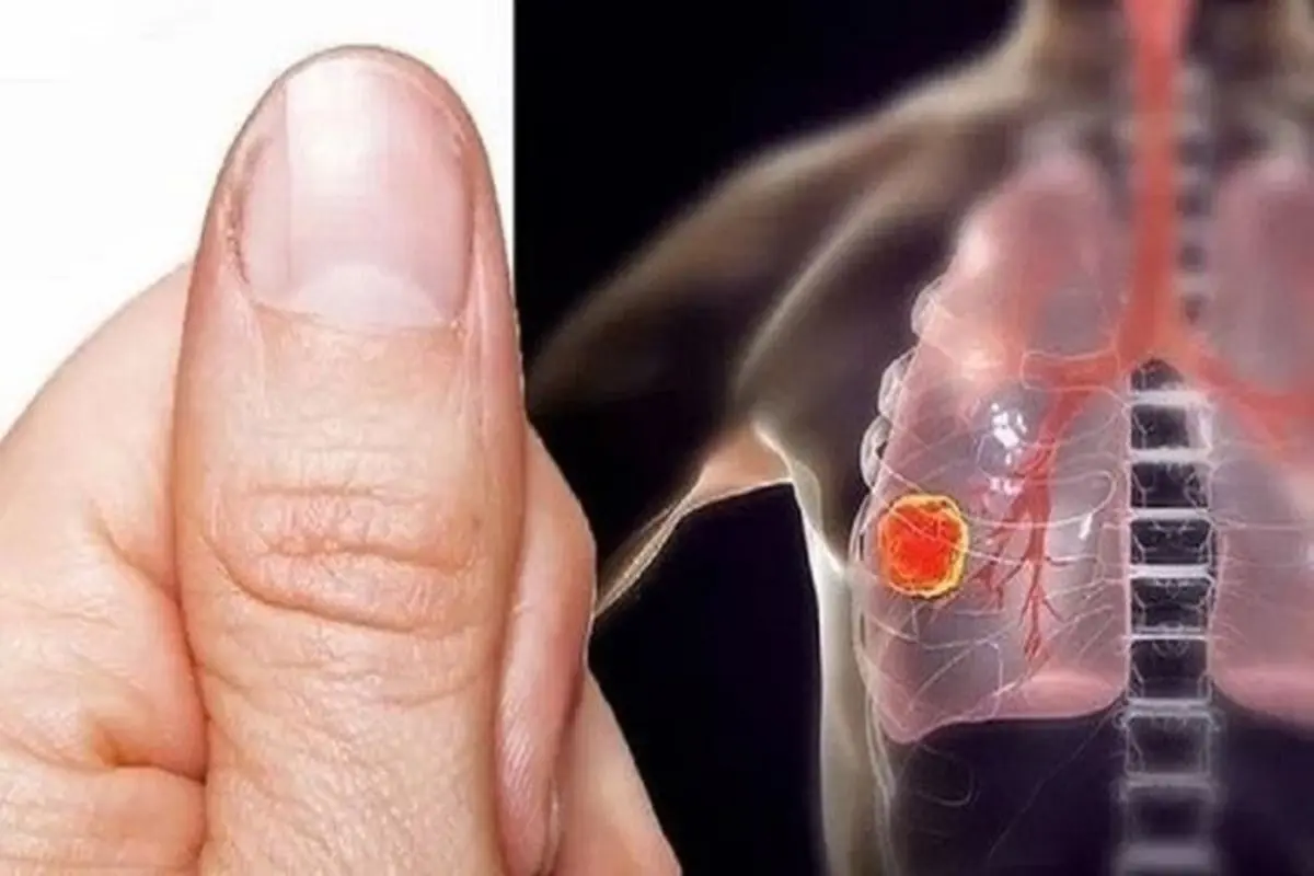 تغییر شکل انگشتان نشانه کدام بیماری است؟