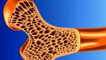چگونه از پوکی استخوان جلوگیری کنیم؟