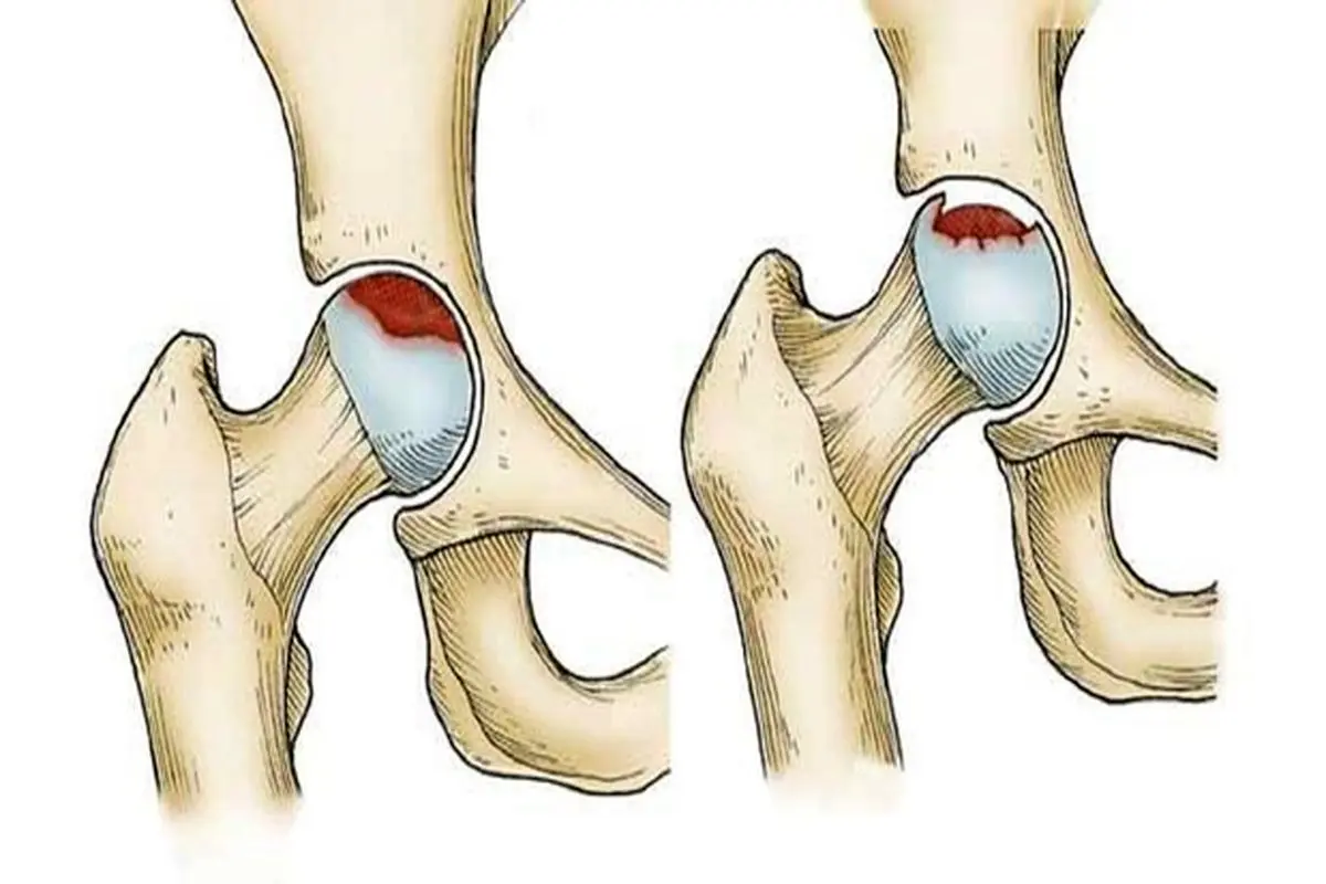 دلایل شایع سیاه شدن سر استخوان ران