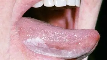 عارضه‌ای که منجر به سرطان دهان می‌شود