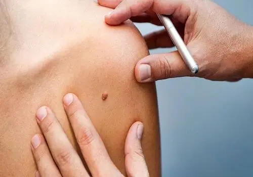 اگر خال شما این ویژگی ها را دارد باید به پزشک مراجعه کنید