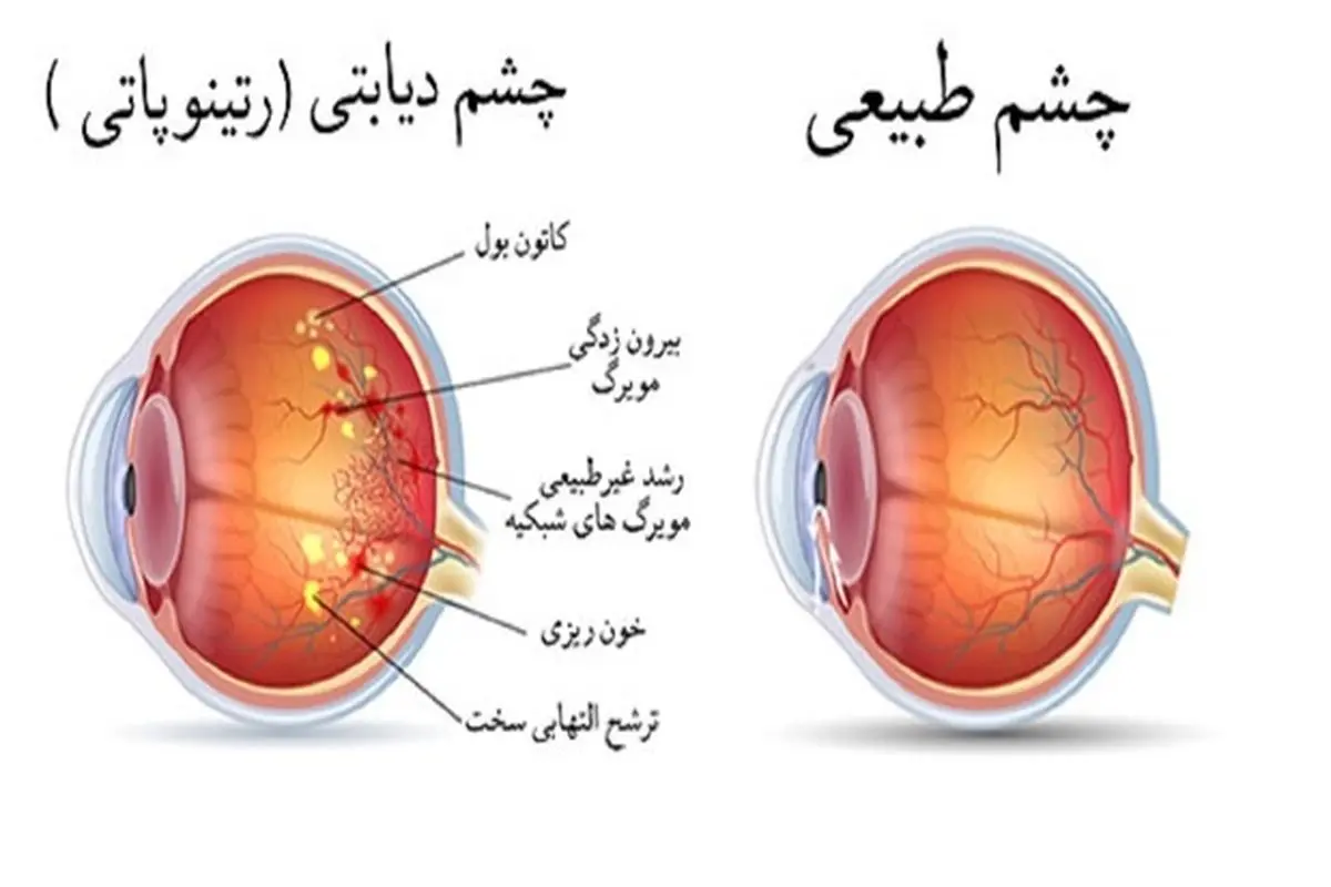 بیماری که بیشترین تغییرات را در شبکیه چشم ایجاد می‌کند