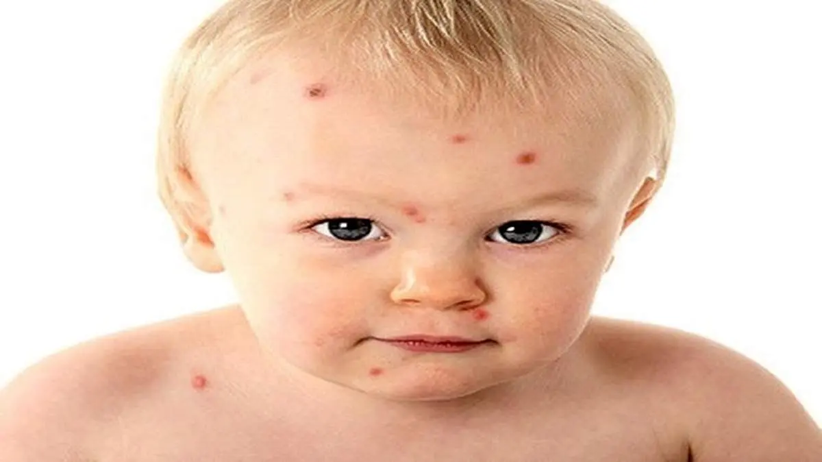 بیماری زونا چیست و چه علائمی دارد؟