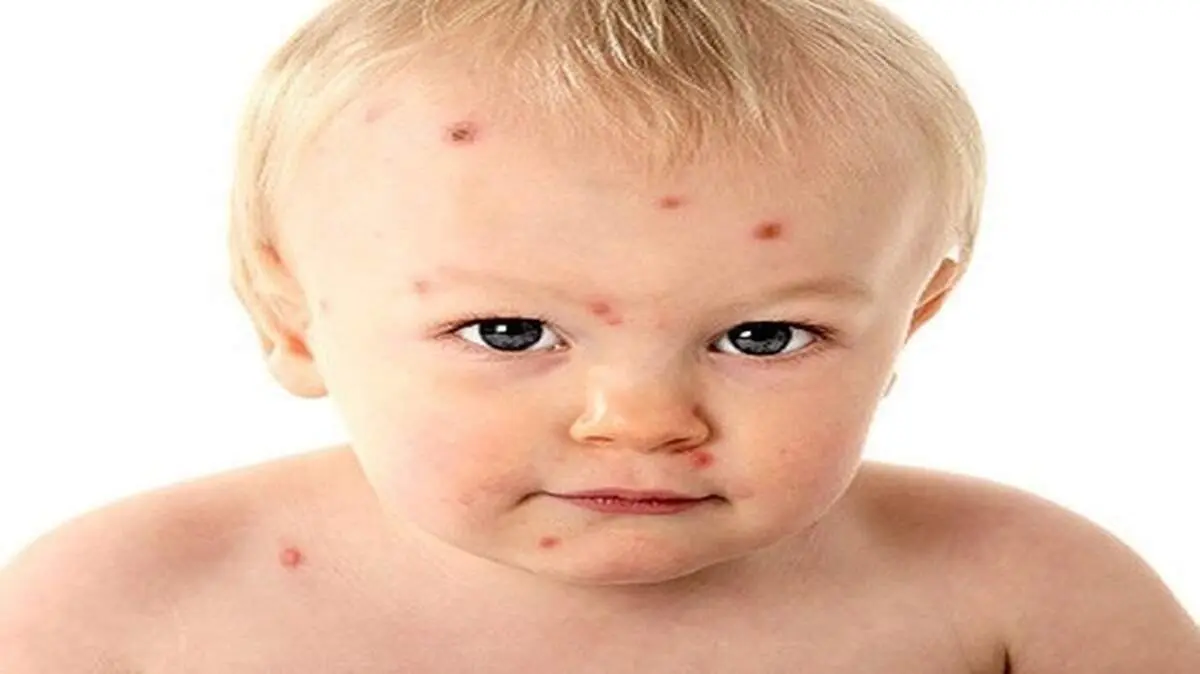 بیماری زونا چیست و چه علائمی دارد؟