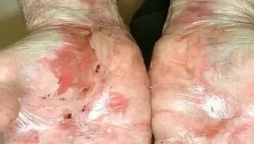 بیماری گوارشی که سیستم ایمنی بدن را هم هدف می‌گیرد