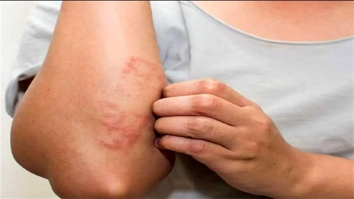 ۷ ماده غذایی که باعث آلرژی غذایی می‌شوند