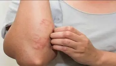 ۷ ماده غذایی که باعث آلرژی غذایی می‌شوند
