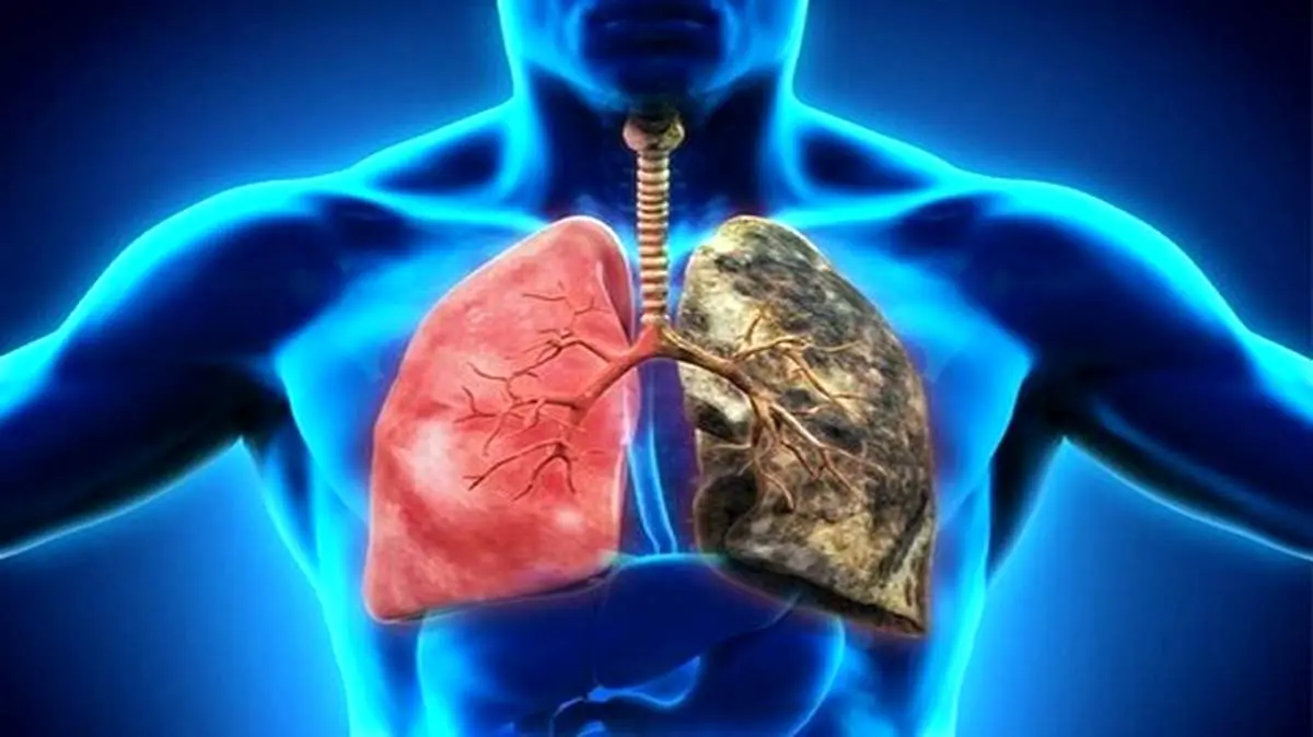 کاهش اکسیژن در ریه با وجود این نوع عارضه