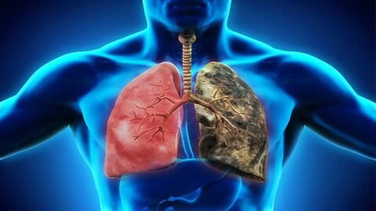 کاهش اکسیژن در ریه با وجود این نوع عارضه