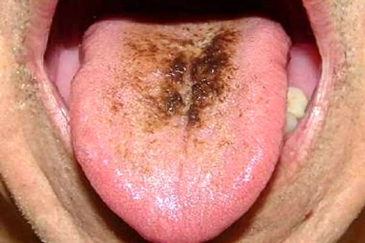 دلایل احتمالی ایجاد لکه‌های تیره بر روی زبان