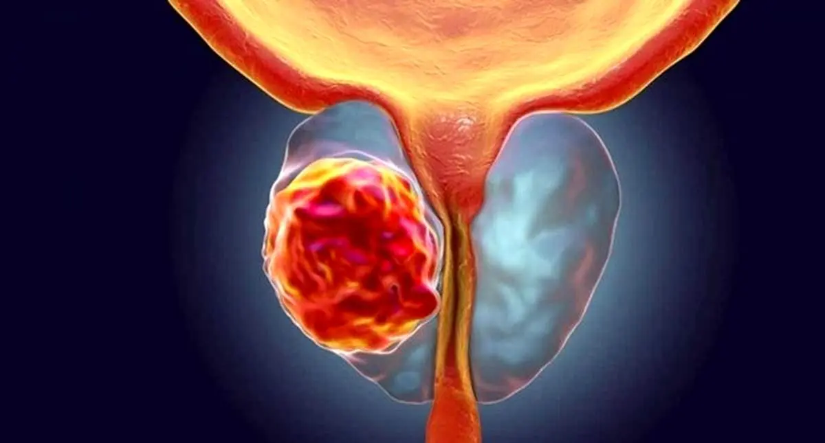 علائم سرطان پروستات در مردان چیست؟