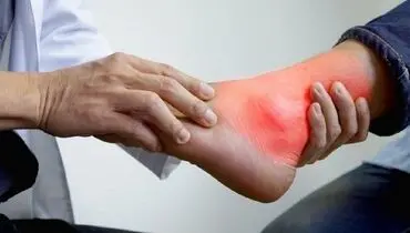 غذا‌های ممنوعه برای مبتلایان به نقرس در افطار