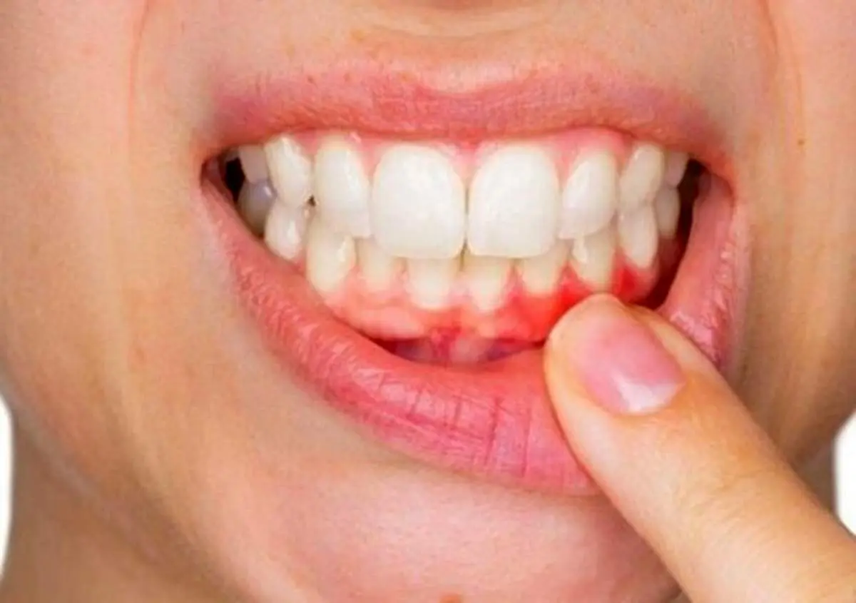 نقش بیماری لثه در ابتلا به نوع شدید کرونا چیست؟