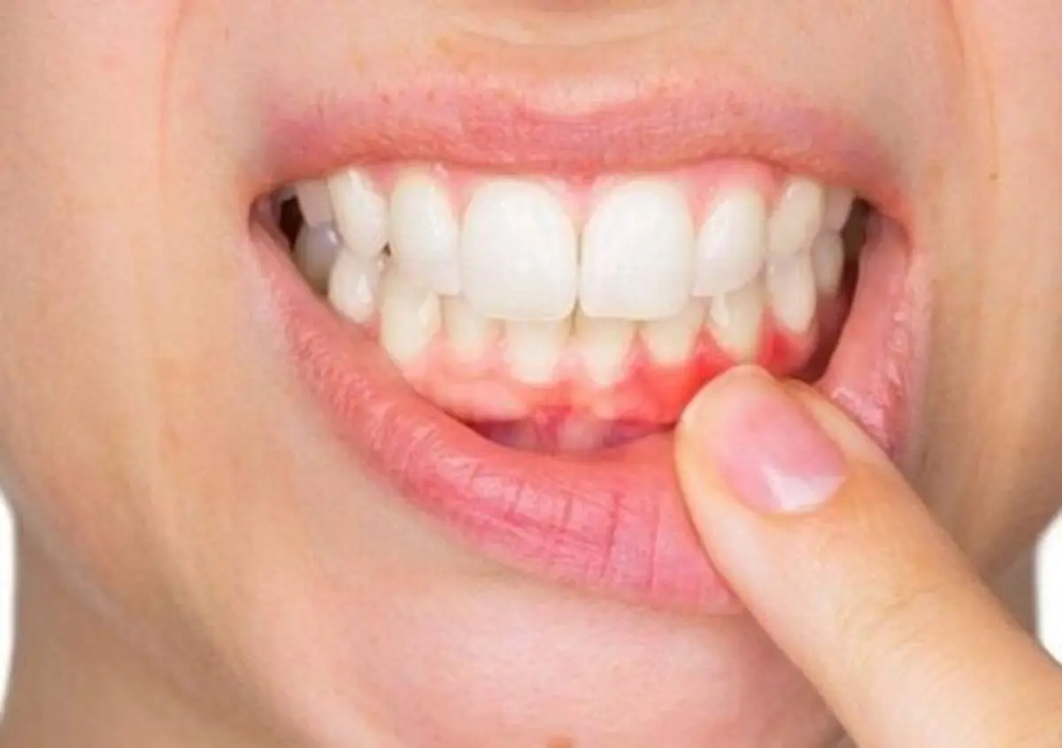 نقش بیماری لثه در ابتلا به نوع شدید کرونا چیست؟