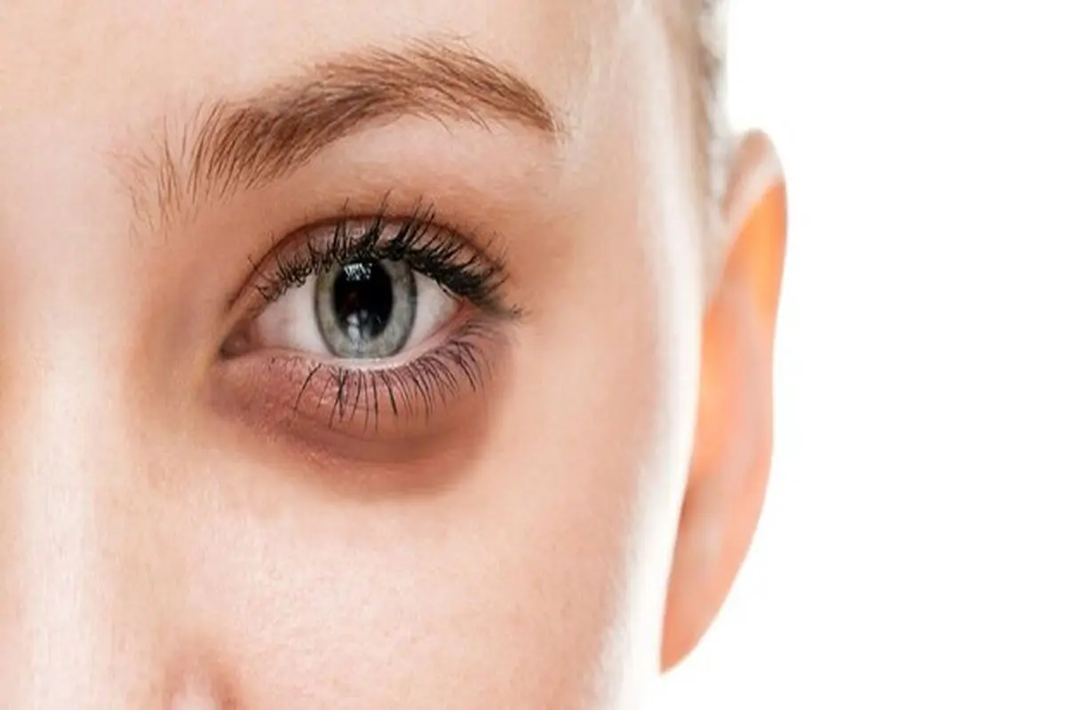 موثرترین راهکار‌ها برای درمان پف صورت
