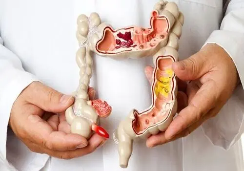افزایش خطر ابتلا به سرطان روده با این رژیم‌غذایی 