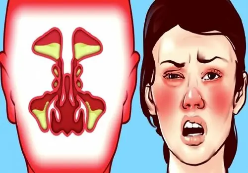 با گرفتگی بینی در فصل بهار چه کنیم؟