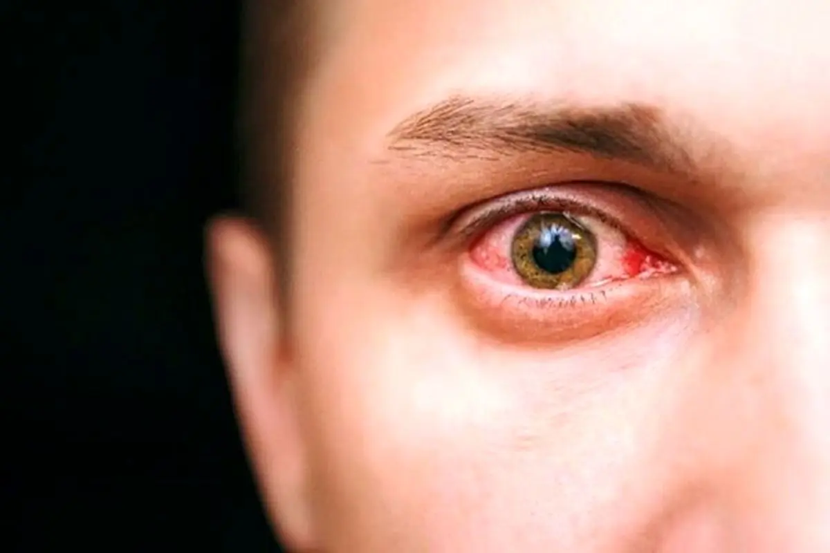 علائم هشدار دهنده ابتلا به سرطان چشم