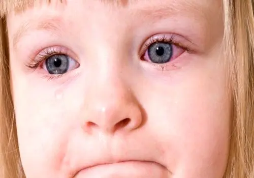 قرمزی چشم علت کدام بیماری است؟