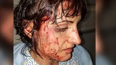 حمله شوهر ماسک داربا چکش به همسرش + عکس