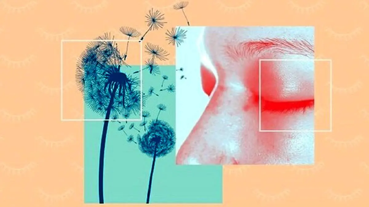 ورم ملتحمه آلرژیک چیست؟ + علائم و روش درمان