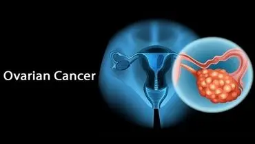 علائم سرطان تخمدان که خانم ها باید توجه کنند