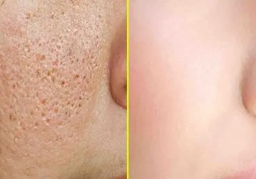 برای رفع قرمزی بعد از اپیلاسیون چه کنیم؟
