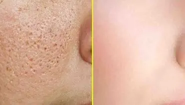 عادت هایی که باعث بسته شدن منافذ پوست می‌شوند