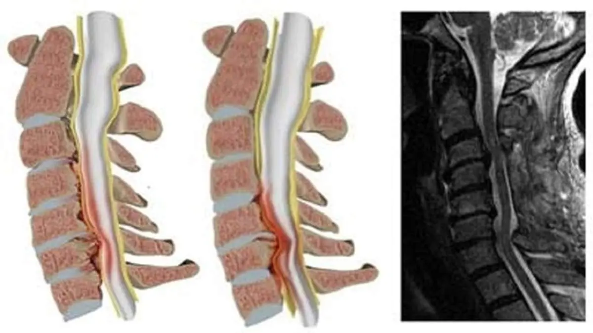 روش‌های درمانی تنگی کانال نخاعی کمر