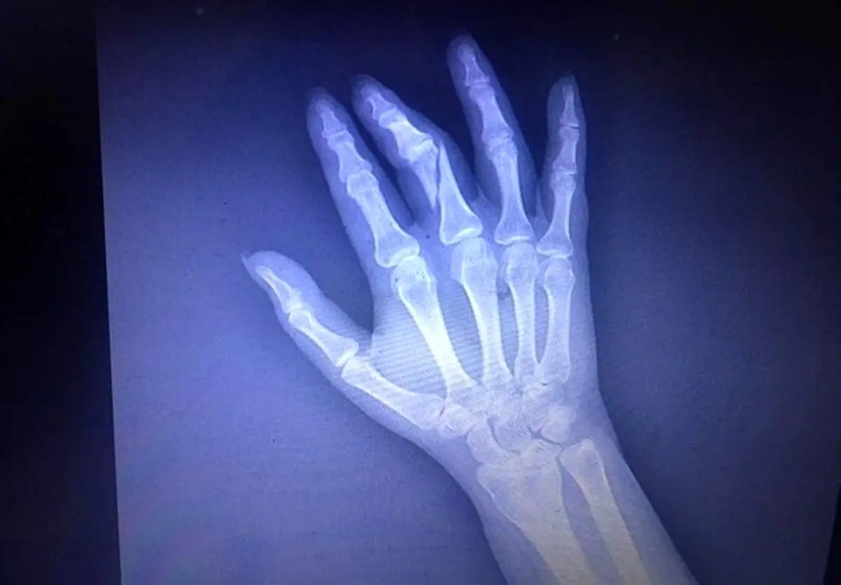 ماجرای شکستن دست خبرنگار به دلیل تهیه گزارش از نحوه واکسیناسیون عمومی + فیلم