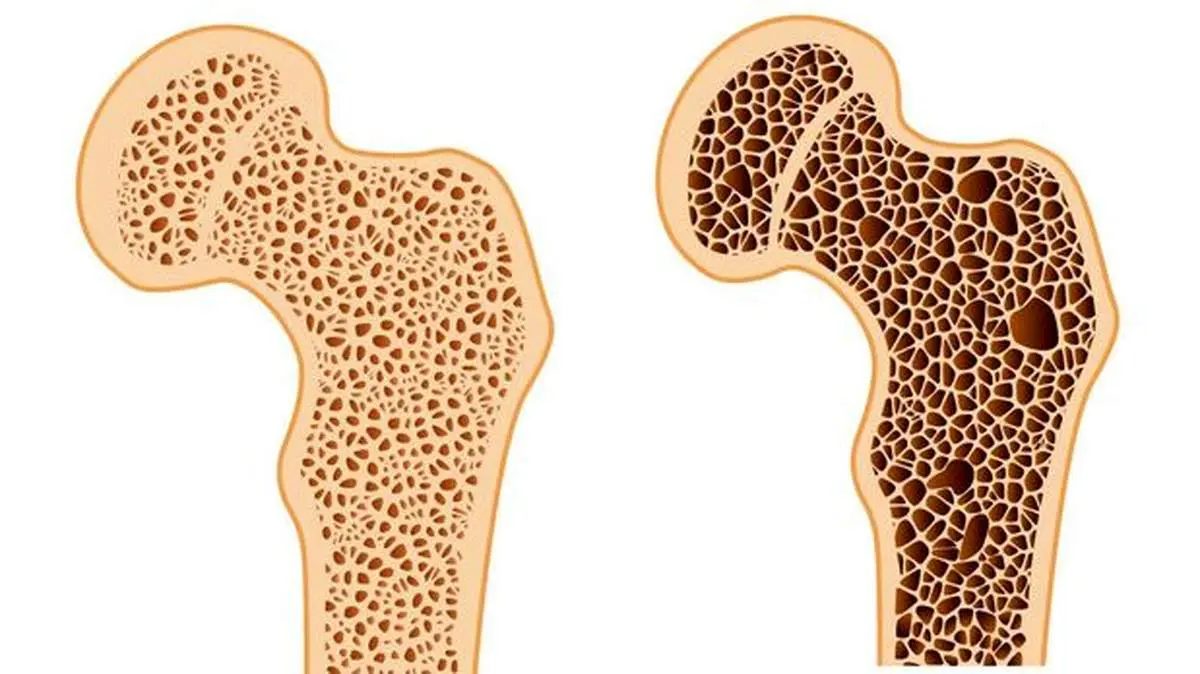 ۵۰ درصد افراد مبتلا به پوکی استخوان دچار این مشکل می‌شوند