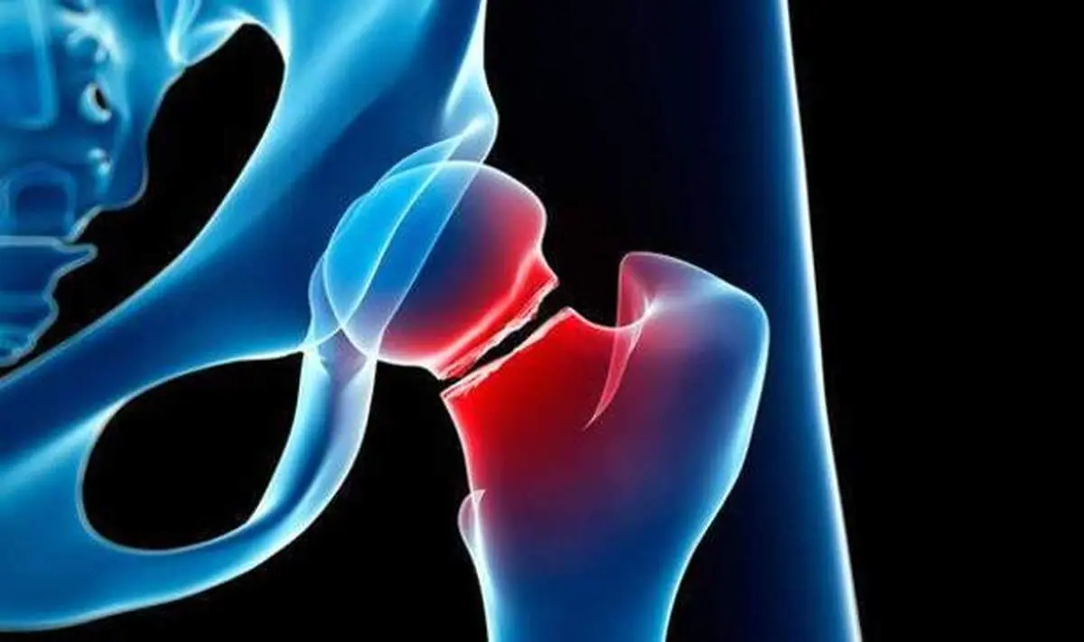 خطر پوکی استخوان با مصرف ۳ ماده غذایی