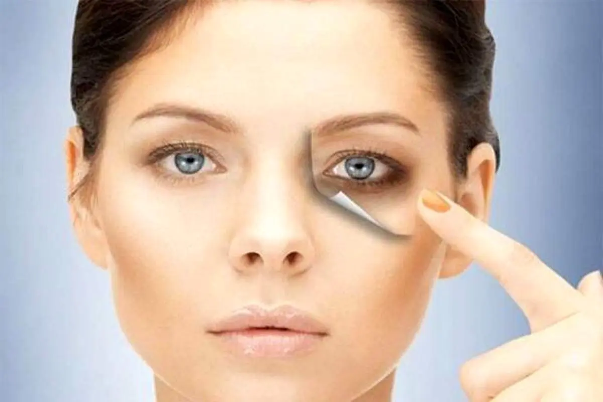 علت تیرگی زیر چشم ها چیست؟ + روش های پیشگیری