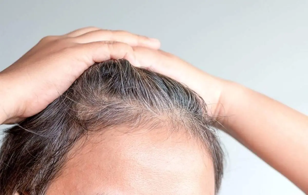 چگونه از سفید شدن موها جلوگیری کنیم؟