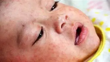 شناسایی ٢۴ مورد سرخک در ایران / خطر طغیان بیماری که ١٠ برابر مسری‌تر از کروناست