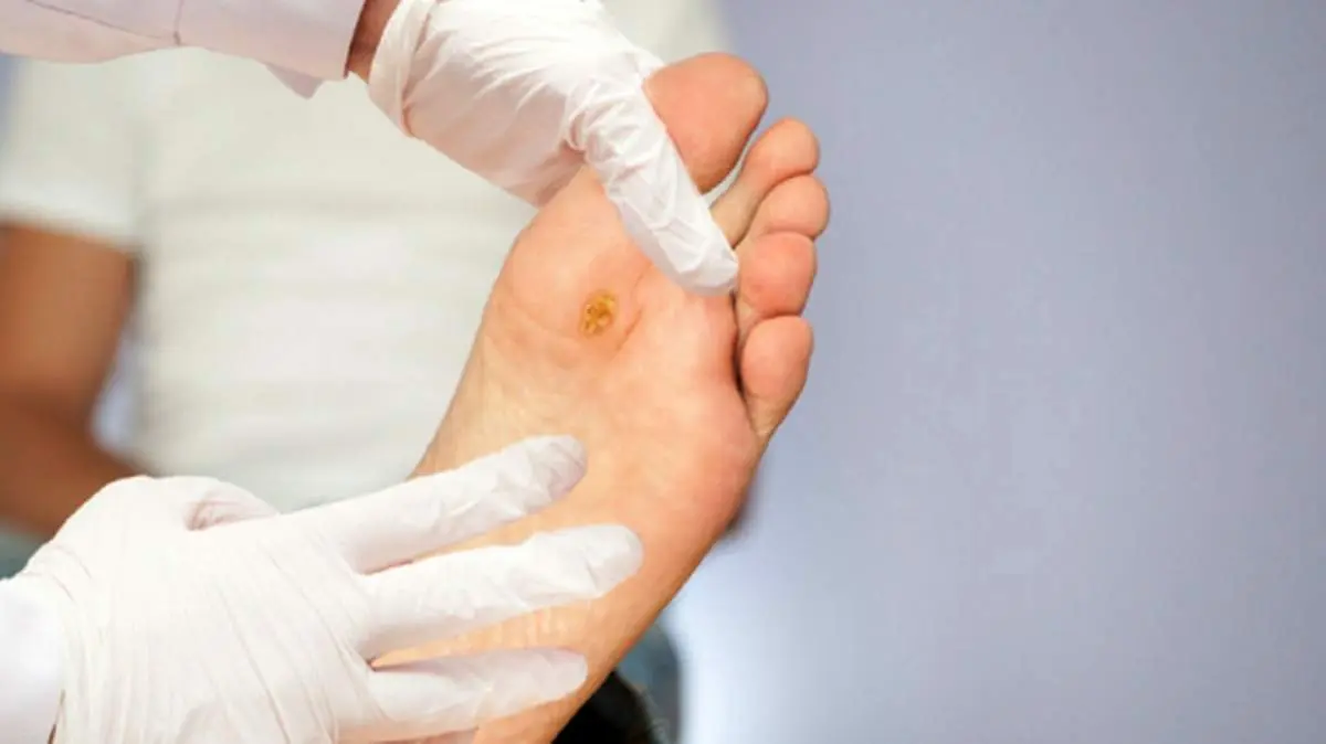 نشانه‌های احتمالی قارچ پوستی + روش درمان قارچ