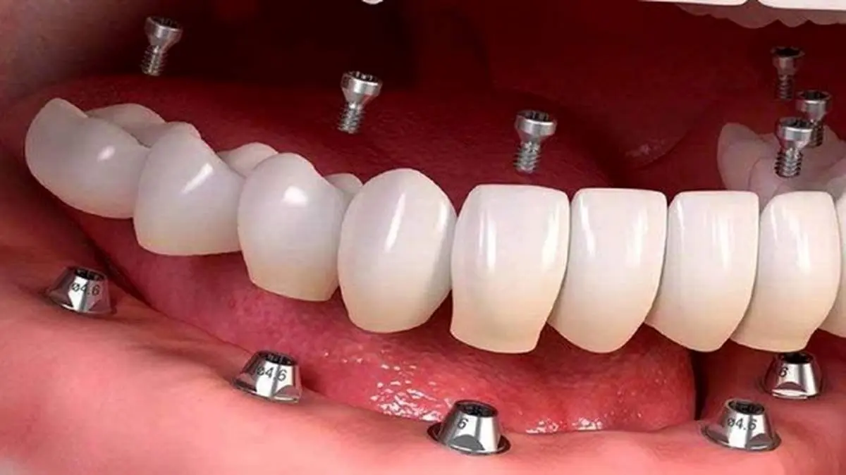 چه زمانی ایمپلنت دندان دچار عفونت میشود؟