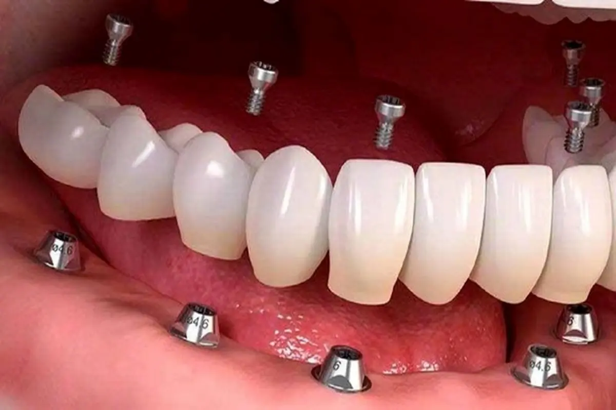 چه زمانی ایمپلنت دندان دچار عفونت می‌شود؟