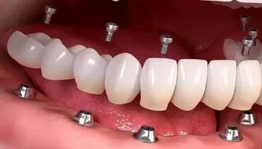 چه زمانی ایمپلنت دندان دچار عفونت می‌شود؟
