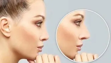 علائم افتادگی دریچه بینی چیست؟ + علل
